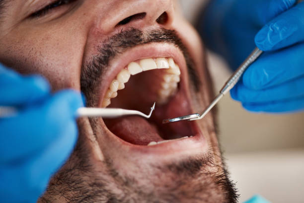 Best Broken or Chipped Tooth Repair in Ava, MO